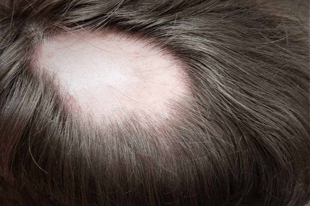 Kreisrunder Haarausfall am Hinterkopf, Beispielsituation