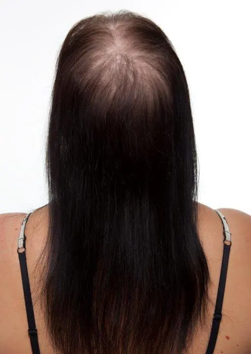 Feines, dünner werdendes Haar vor der Haarverdichtung